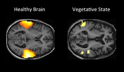 fmri